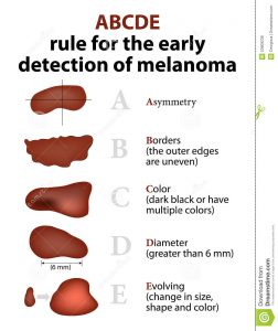 5 signs of melanoma